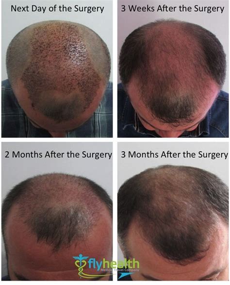 After hair restoration, the hair growth timeline requires patience. Hair Transplant Growth Timeline: How Your Head Looks After ...