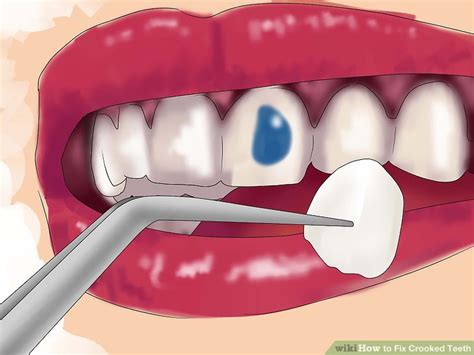 Whether only one arch or both upper and lower crooked teeth are getting in the way of your confidence, ther. 5 Ways to Fix Crooked Teeth - wikiHow