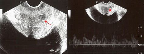 Cureus Evaluation Of Prostatic Lesions By Transrectal Ultrasound