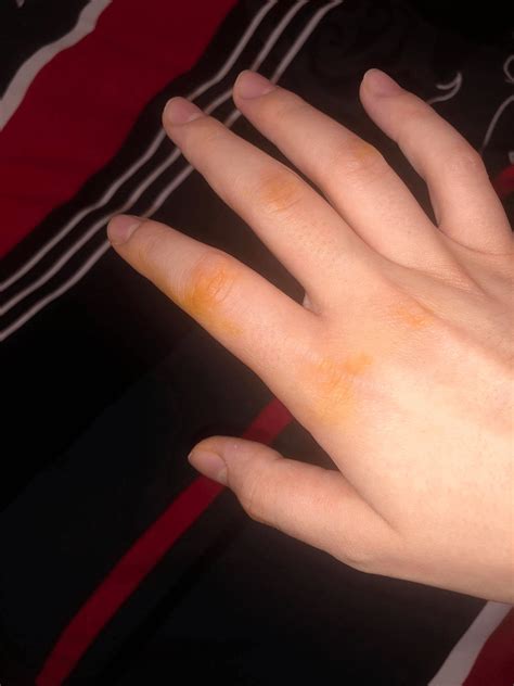 Weird Yelloworange Stains On My Hand Without Touching Anything Strange
