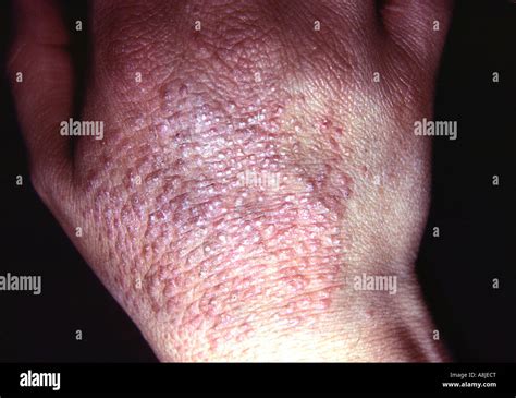Contact Dermatitis On Hand Eczematous Reaction Could Be Caused By Gloves Or A Chemical Stock