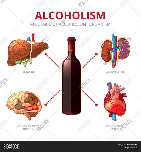 Long Term Effects Of Alcohol Alcoholism Vector Infographic Stock