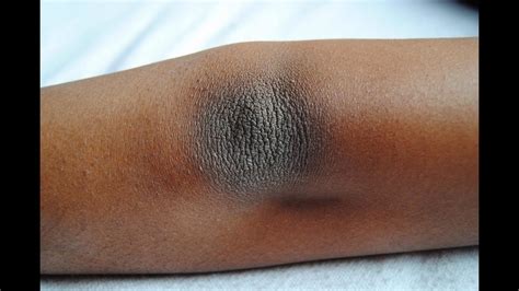 Home Remedies For Dark Elbows And Knees How To Treat Dark Elbows