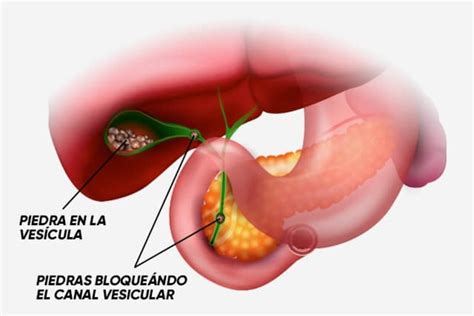 Tratar la inflamación de la vesícula