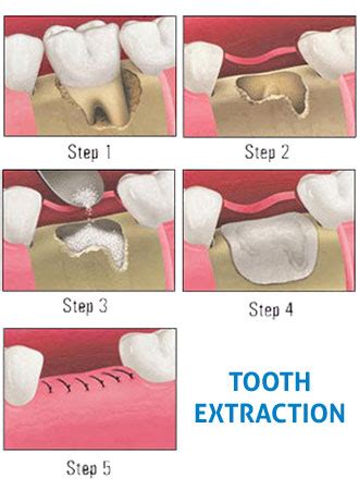 However, there is always a risk when it comes to performing any surgery. dentistry for children : Simple and Surgical Extractions