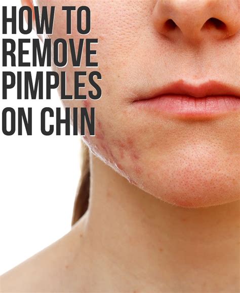 Chin Acne What Is It Causes And How To Get Rid Of It Chin Acne