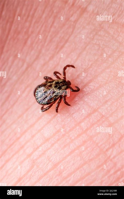 Infectious Encephalitis Tick Insect On Skin Encephalitis Virus Or Lyme