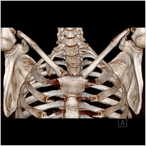 Cervical Rib With Accessory Articulation The Third Eye Radiology Site