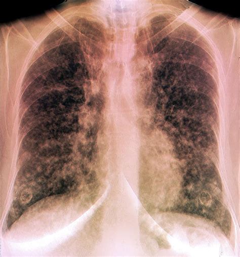 Terminal Lung Cancer 1 Photograph By Zephyrscience Photo Library Pixels