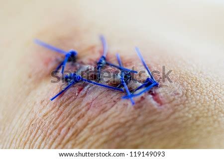 Mar 03, 2018 · you will need to use water to clean the wound, but submerging the wound or exposing it to excessive moisture can negatively impact the stitches' integrity. Surgical Stitches Stock Photos, Images, & Pictures ...