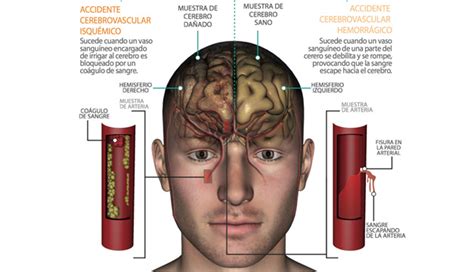 Cu Ndo Ocurre Un Accidente Cerebrovascular Diario El Mundo