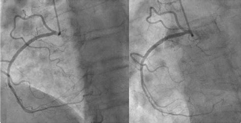 Image 3 Normal Coronary Angiogram Of Right Coronary Artery