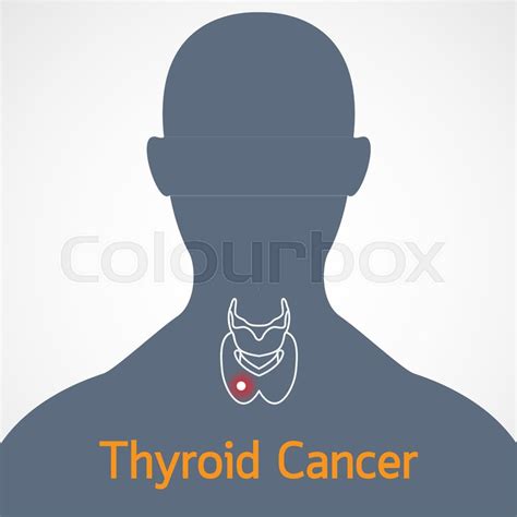 Thyroid Cancer Vector Icon Stock Vector Colourbox
