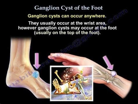 Ganglion cysts are fluid filled sacs composed of synovial fluid from a tendon sheath or joint. Ganglion Cyst Of The Foot - Everything You Need To Know ...