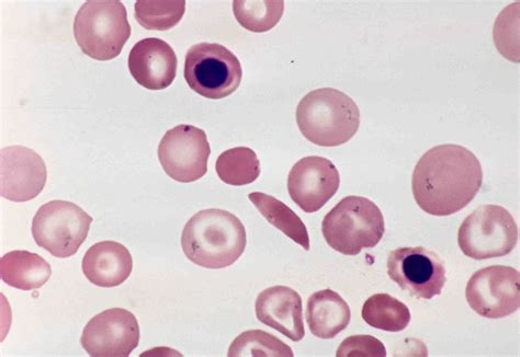 Why Do You See Howell Jolly Bodies In Sickle Cell Anemia Pathology