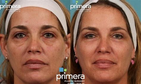 Chemical Peel Before And After Photo Gallery Orlando Florida