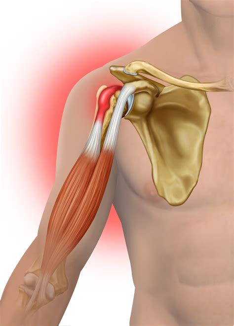 Tenossinovite Da Cabeça Longa Do Biceps