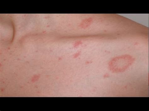 The rash begins with a herald patch and continues to spread in a characteristic pattern, typically over the course of six to eight weeks. Pityriasis rosea (English version) - YouTube
