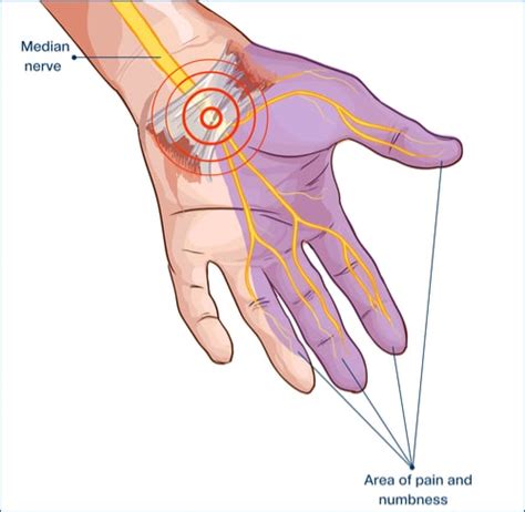 What Is Carpal Tunnel Syndrome Understanding And Treating Cts