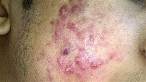 Return to your surgeon so that they may evaluate your scars and help get them to fade as quickly as possible. How Long Does It Take For Acne Scars To Fade