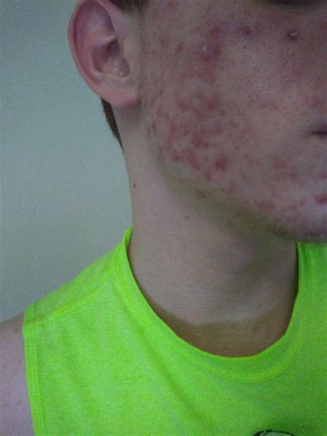 Acne Is Killing Me Help General Acne Discussion Forum