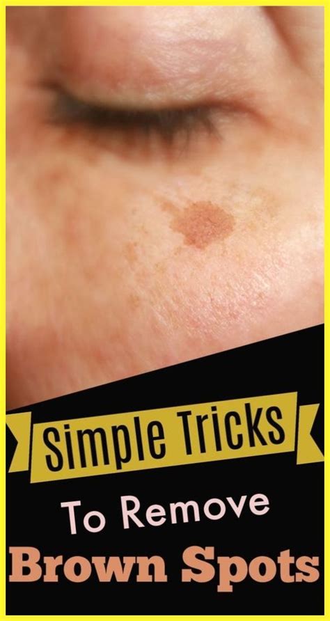 Remove Blackheads With One Simple And Effective Trick Brown Spots On Hands Dark Spots Health