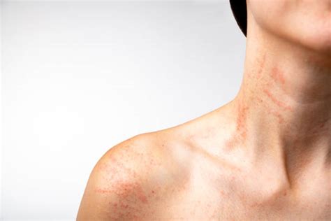 630 Neck Rash Stock Photos Pictures And Royalty Free Images Istock