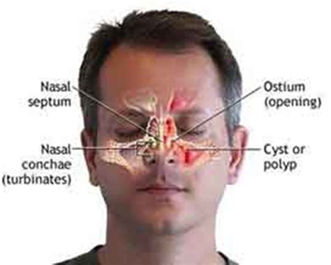 Nasal polyps (figures 1) are growths or swellings from the lining (mucosa) of your nose and sinuses. Nasal Polyps Treatment: Do I Have Nasal Polyps?