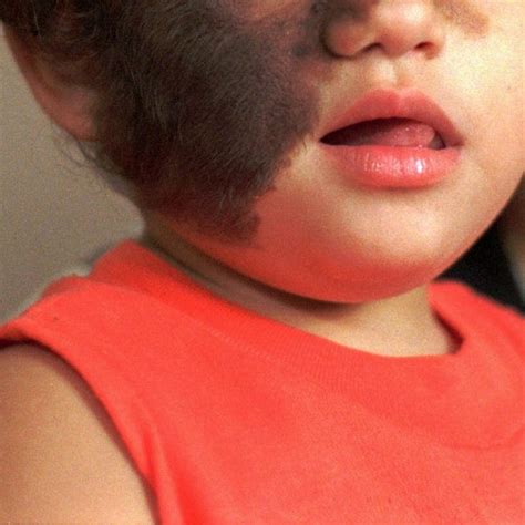Fast baby hair growth is something that parents are always worried about. 'Werewolf syndrome': 17 babies with out-of-control hair ...