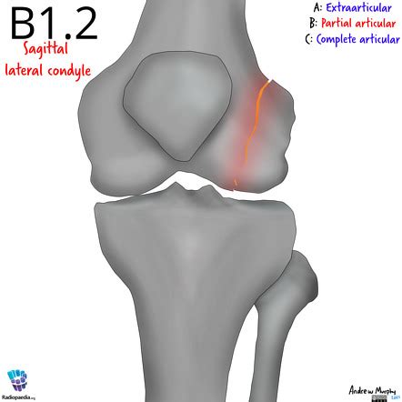 Ao Classification Of Distal Femur Fractures Illustration Image