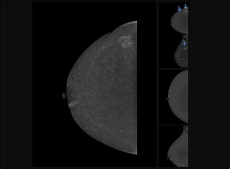 Titanium Contrast Enhanced Mammography Ticem With 50° Wide Angle Hd