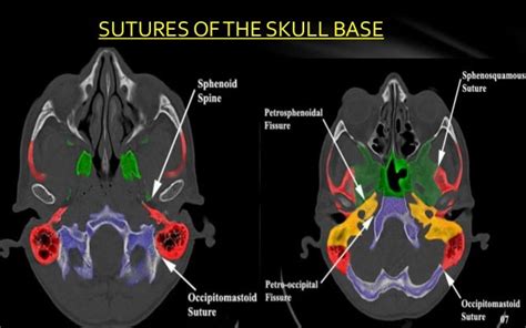 Skull base anatomy by Dr. Aditya Tiwari