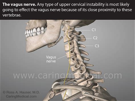 Cervical Spine Problems Vagus Nerve Compression Urinary Incontinence