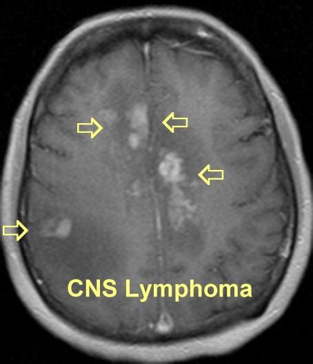 Brain Cns Lymphoma