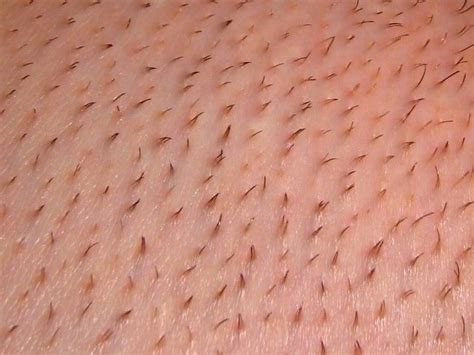 Chin and facial hair are about a 2 or 3 out of 10 by comparison. bikini line laser hair removal