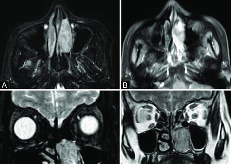 A D Left Sinonasal Schwannoma Axial T Fat Suppressed A And Axial