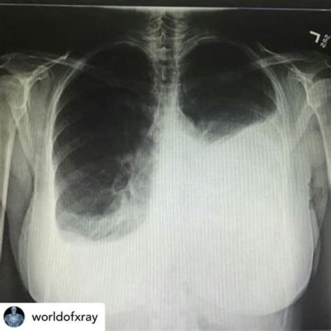 If water collects in the lungs due to heart failure, diuretics help the body remove it through the urine. World of X-Ray on Instagram: "Pleural effusion is fluid in ...