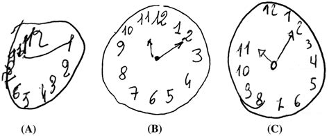 Moca scoring nuances with clock draw : Three examples of Clock Drawing Test (CDT) using rouleau ...