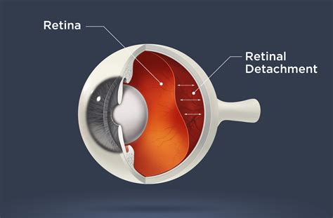 Detached Retina Also Retinal Detachment