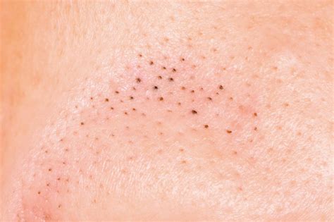 Types Of Acne Causes And Best Treatments Vibrantskinbar