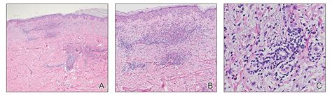 Sweet Syndrome With Marked Eosinophilic Infiltrate Mdedge Dermatology
