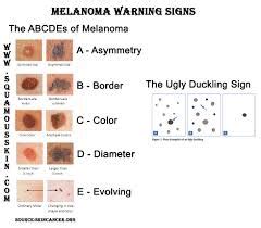 What does melanoma under the nail look like? Avenue Clinic June Newsletter - Avenue Chiropractic Clinic ...