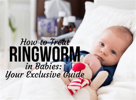 How To Treat Ringworm In Babies Your Exclusive Guide Baby Care Mag