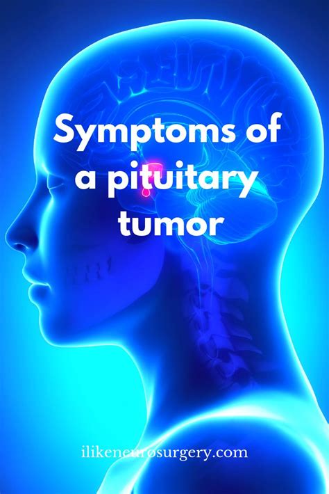 Balance problems and seizures could also happen. Symptoms of pituitary tumors | I like neurosurgery | Brain ...