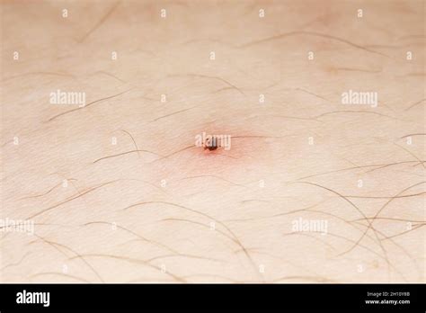Sucking Tick Macro Photo On Human Skin Ixodes Ricinus Dangerous Mite