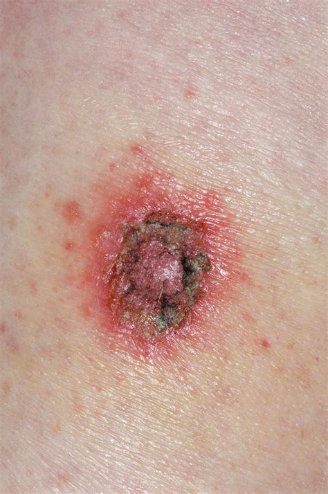 Discoid Eczema Photograph By Dr P Marazziscience Photo Library