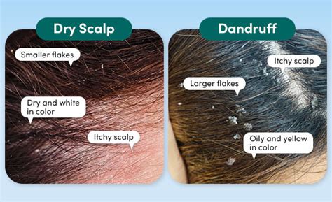 Dandruff Vs Dry Scalp How To Tell The Difference Coco And Eve