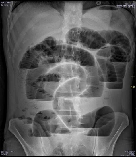 Large Bowel Obstruction X Ray Danikaexoneal