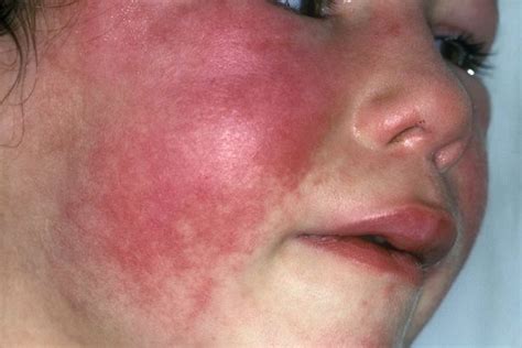 Scarlet Fever Cases In Nottinghamshire Are Three Times Higher Than Last