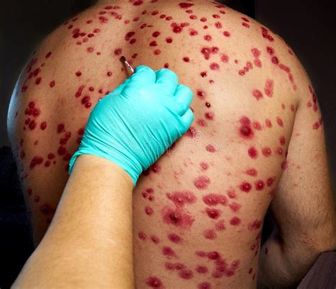 We order all of our genuine medication from. Shingles Rash On Man S Neck And Face Stock Image - Image of erythema, painful: 23691839
